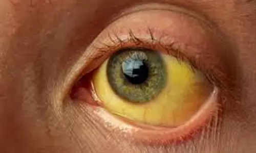 കാര്യം നിസ്സാരമല്ല; മഞ്ഞപ്പിത്തത്തെ ജാഗ്രതയോടെ കാണണം -ജില്ല പഞ്ചായത്ത്