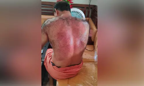 ന​ഗ​ര​സ​ഭ കൗ​ൺ​സി​ല​ർ​ക്ക് സൂ​ര്യാ​ത​പ​മേ​റ്റു