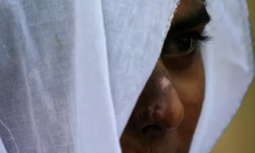 ആസിഡ് ഒഴിച്ച് വധശ്രമം: പ്രതിക്ക് 20 വർഷം കഠിനതടവും 75,000 രൂപ പിഴയും
