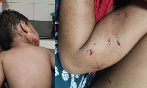 സഹോദരനൊപ്പം വീട്ടുമുറ്റത്ത് കളിക്കവെ പിഞ്ചുകുഞ്ഞിനെ തെരുവ് നായ്ക്കൂട്ടം ആക്രമിച്ചു സഹോദരനൊപ്പം വീട്ടുമുറ്റത്ത് കളിക്കവെ പിഞ്ചുകുഞ്ഞിനെ തെരുവ് നായ്ക്കൂട്ടം ആക്രമിച്ചു