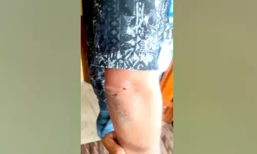 സെൻസസ് ഡ്യൂട്ടിക്കിടെ ഉദ്യോഗസ്ഥന് വളർത്തുനായുടെ കടിയേറ്റു