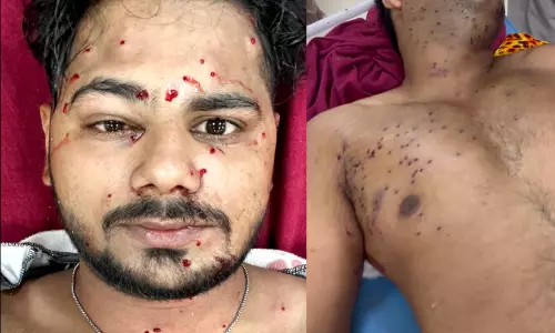 വിദ്യാർഥികൾക്ക് നേരെ പെല്ലറ്റ് ക്രൂരതയും; കശ്മീരിൽ പ്രയോഗിച്ച പെല്ലറ്റ് തോക്കുകൾ ഉപയോഗിച്ചു; നിരവധി പേർക്ക് സാരമായ പരിക്ക്
