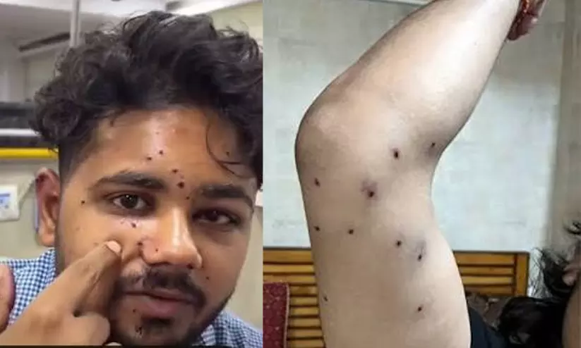 പെല്ലറ്റ് ആക്രമണത്തിനിരയായ വിദ്യാർഥിയുടെ കാഴ്ച ശക്തി നഷ്ടപ്പെട്ടേക്കും; വീണ്ടെടുക്കാനുള്ള സാധ്യത ഒരു ശതമാനം മാത്രമെന്ന് റിപ്പോർട്ട് പെല്ലറ്റ് ആക്രമണത്തിനിരയായ വിദ്യാർഥിയുടെ കാഴ്ച ശക്തി നഷ്ടപ്പെട്ടേക്കും; വീണ്ടെടുക്കാനുള്ള സാധ്യത ഒരു ശതമാനം മാത്രമെന്ന് റിപ്പോർട്ട്