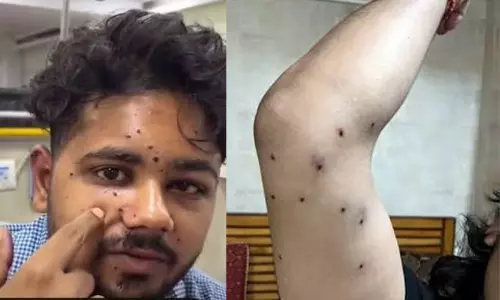 പെല്ലറ്റ് ആക്രമണത്തിനിരയായ വിദ്യാർഥിയുടെ കാഴ്ച ശക്തി നഷ്ടപ്പെട്ടേക്കും; വീണ്ടെടുക്കാനുള്ള സാധ്യത ഒരു ശതമാനം മാത്രമെന്ന് റിപ്പോർട്ട്