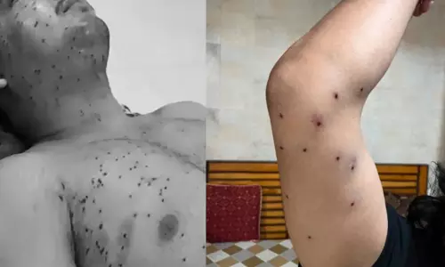 വിദ്യാർഥിയുടെ ശരീരത്തിൽ 30ലേറെ പെല്ലറ്റ് പരിക്കുകൾ, അരക്ക് താഴേക്ക് മാത്രം പ്രയോഗിക്കേണ്ട ഇവ കൈമുട്ടിലും മുതുകിലുമാണ് തറച്ചിരിക്കുന്നത്, അന്വേഷണ റിപ്പോർട്ട് അടുത്ത ആഴ്ച സമർപ്പിച്ചേക്കും