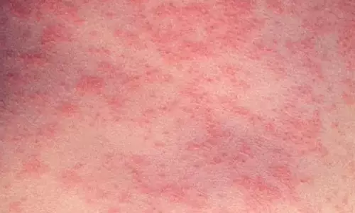 അഞ്ചാംപനി വ്യാപിക്കുന്നു; നഷ്ടമായത് മൂന്ന് കുട്ടികളുടെ ജീവൻ അഞ്ചാംപനി വ്യാപിക്കുന്നു; നഷ്ടമായത് മൂന്ന് കുട്ടികളുടെ ജീവൻ