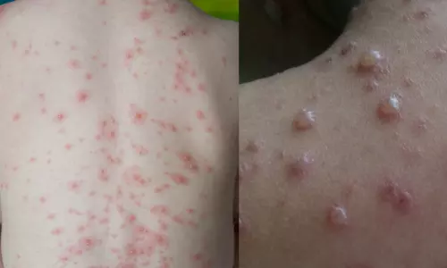 ചിക്കൻപോക്സ്; ഈ വർഷം ഒമ്പത് മരണം, കുട്ടികളിൽ രോഗം വ്യാപനം