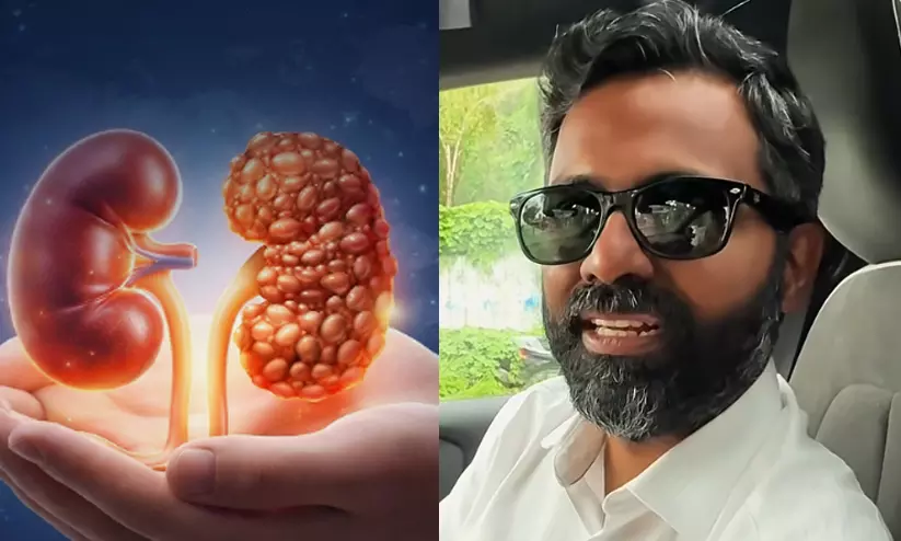 വെളുക്കാൻ ക്രീം തേക്കാം, പക്ഷേ കിഡ്നി അടിച്ചുപോകാതെ നോക്കണം!; 35 കാരന് മെംബറേനിയസ് നെഫ്രോപ്പതി ബാധിച്ചതെങ്ങനെ, മുന്നറിയിപ്പുമായി നെഫ്രോളജിസ്റ്റ് വെളുക്കാൻ ക്രീം തേക്കാം, പക്ഷേ കിഡ്നി അടിച്ചുപോകാതെ നോക്കണം!; 35 കാരന് മെംബറേനിയസ് നെഫ്രോപ്പതി ബാധിച്ചതെങ്ങനെ, മുന്നറിയിപ്പുമായി നെഫ്രോളജിസ്റ്റ്