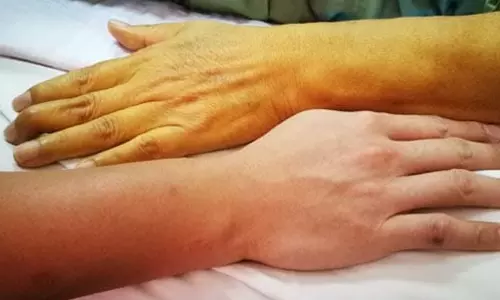 മ​ഞ്ഞ​പ്പി​ത്ത പ്ര​തി​രോ​ധം പ​രി​ശോ​ധ​ന ക​ർ​ശ​ന​മാ​യി തു​ട​രും; നി​ല​മ്പൂ​ർ ന​ഗ​ര​സ​ഭ​യി​ൽ അ​ടി​യ​ന്ത​ര യോ​ഗം ചേ​ർ​ന്നു