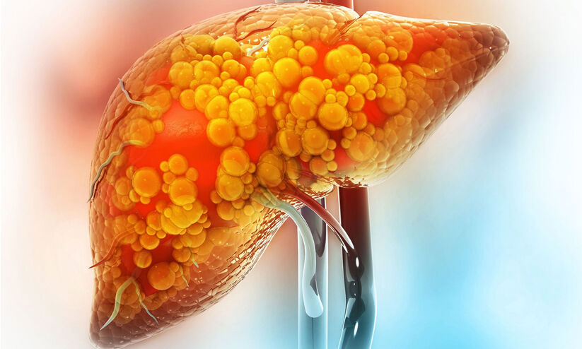 ഫാറ്റിലിവർ സ്വയം തിരിച്ചറിയാനുള്ള 5 വഴികൾ ഫാറ്റിലിവർ സ്വയം തിരിച്ചറിയാനുള്ള 5 വഴികൾ