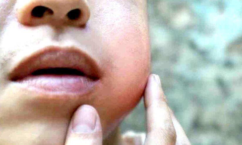 മുണ്ടിനീർ രോഗം വ്യാപിക്കുന്നു; രോഗ ബാധിതർ ഏറെയും വിദ്യാർഥികൾ മുണ്ടിനീർ രോഗം വ്യാപിക്കുന്നു; രോഗ ബാധിതർ ഏറെയും വിദ്യാർഥികൾ