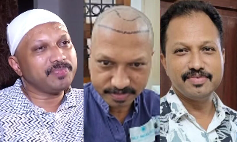 ഹെയർ ട്രാൻസ്പ്ലാന്‍റേഷന് പിന്നാലെ തലയിൽ മാംസം ഭക്ഷിക്കുന്ന ബാക്ടീരിയ, തലയോട്ടി പുറത്ത് കാണുന്ന അവസ്ഥ; വേദന തിന്ന് യുവാവ്