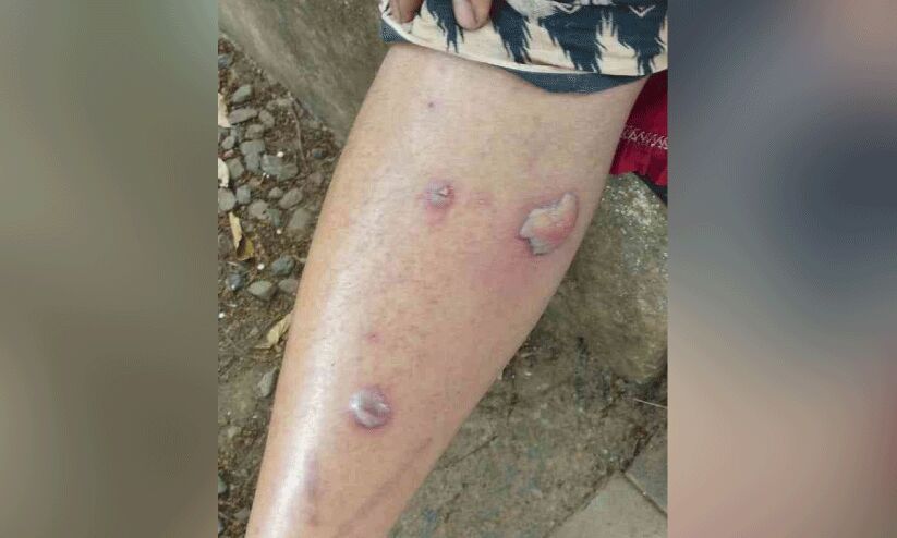 ഒമ്പത് പേർക്ക് സൂര്യാതാപമേറ്റു