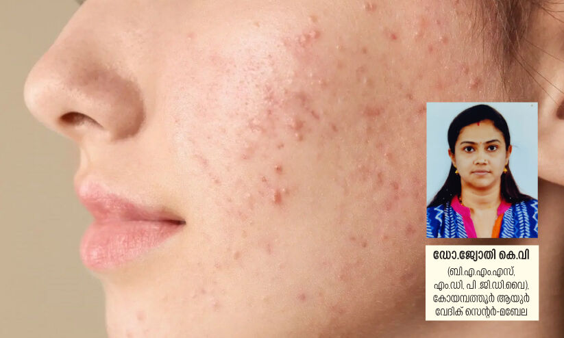 മുഖക്കുരു: നേടാം പരിഹാരം ആയുർവേദത്തിലൂടെ മുഖക്കുരു: നേടാം പരിഹാരം ആയുർവേദത്തിലൂടെ