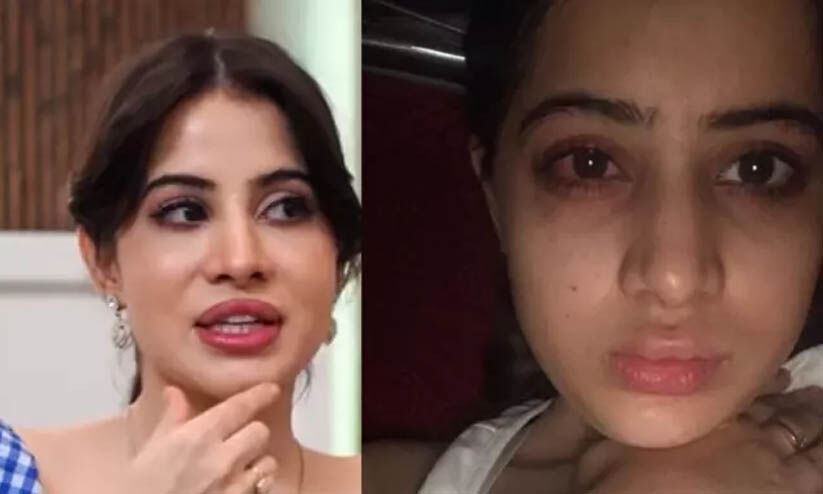 ചുണ്ടിന് സൗന്ദര്യം കൂട്ടാൻ ചികിത്സ, തടിച്ചുവീർത്തു, ലിപ് ഫില്ലർ പണി തന്നുവെന്ന് ഉർഫി ജാവേദ് ചുണ്ടിന് സൗന്ദര്യം കൂട്ടാൻ ചികിത്സ, തടിച്ചുവീർത്തു, ലിപ് ഫില്ലർ പണി തന്നുവെന്ന് ഉർഫി ജാവേദ്