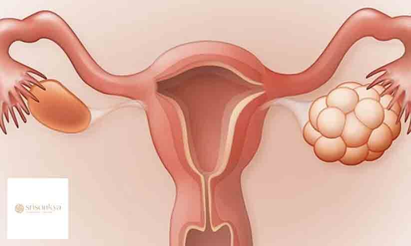 പി.സി.ഒ.ഡിയും ആയുർവേദവും പി.സി.ഒ.ഡിയും ആയുർവേദവും