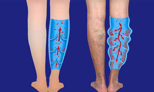 വെരിക്കോസ് വെയ്ന് ശ്രദ്ധ വേണം വെരിക്കോസ് വെയ്ന് ശ്രദ്ധ വേണം