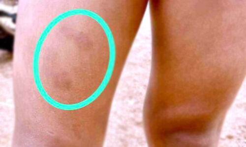 അംഗൻവാടി ടീച്ചർ കുട്ടിയെ പരിക്കേൽപിച്ചതായി പരാതി