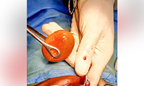 പരിമിത സാഹചര്യങ്ങളിൽ ശസ്ത്രക്രിയ; വ​യോ​ധി​ക​ന്‍റെ മൂ​ത്ര​സ​ഞ്ചി​യി​ൽ നി​ന്ന് ആ​റ് സെ​ന്‍റി​മീ​റ്റ​ർ വ​ലി​പ്പ​മു​ള്ള ക​ല്ല് നീ​ക്കം ചെ​യ്തു