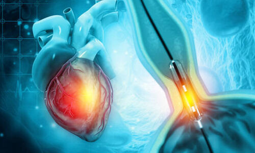 ആ​ൻ​ജി​യോ​പ്ലാ​സ്റ്റി​യി​ൽ ന​ല്ല ഇ​മേ​ജി​ങ്ങി​ന്റെ പ്രാ​ധാ​ന്യം