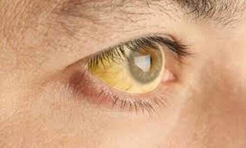 കിഴക്കോത്ത് പന്നൂരിൽ മഞ്ഞപ്പിത്തം പടരുന്നു കിഴക്കോത്ത് പന്നൂരിൽ മഞ്ഞപ്പിത്തം പടരുന്നു