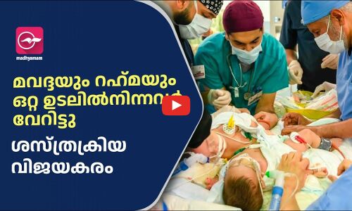 മവദ്ദയും റഹ്​മയും ഒറ്റ ഉടലിൽനിന്നവർ വേറിട്ടു; ശസ്​ത്രക്രിയ വിജയകരം