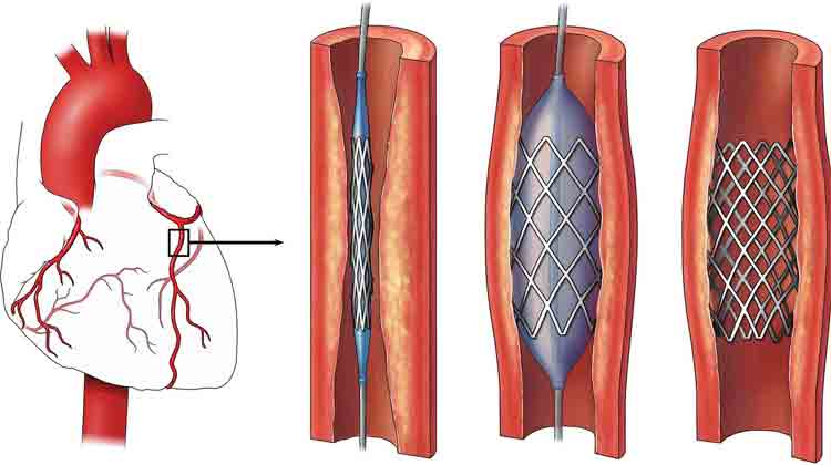 Angioplasty-Stent