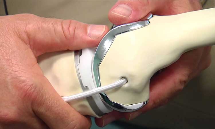 Artificial-Joints Artificial-Joints