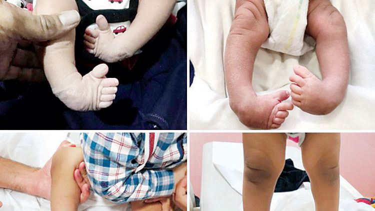 സി​ദ്റ​യി​ൽ വ​രൂ; കു​ഞ്ഞു​ങ്ങ​ളു​ടെ  ‘ക്ല​ബ്ഫൂ​ട്ട്​’ രോ​ഗം ഭേ​ദ​മാ​ക്കാം