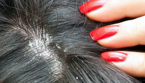 DANDRUFF