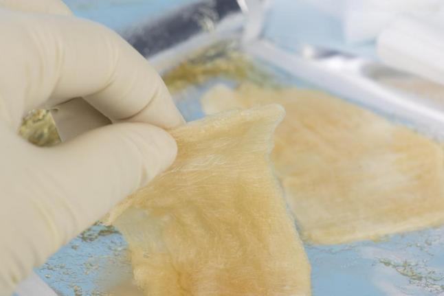 മുറിവുണക്കാന്‍ ഇനി ഇലാസ്റ്റിക് ജെല്ലും