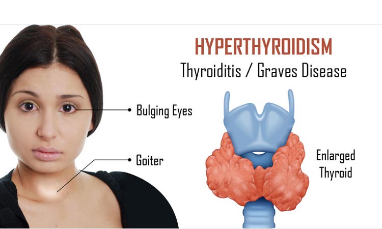 Hyper-thyroidism