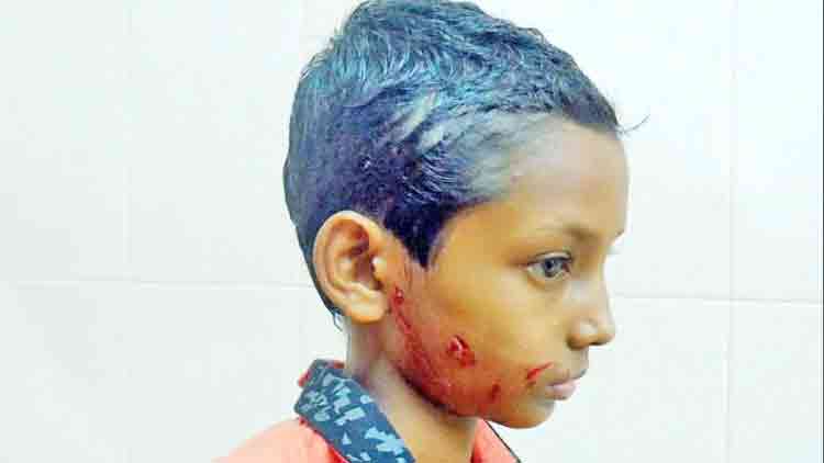 അഞ്ചാം ക്ലാസുകാര​െൻറ മുഖം തെരുവുനായ്​ കടിച്ചുകീറി