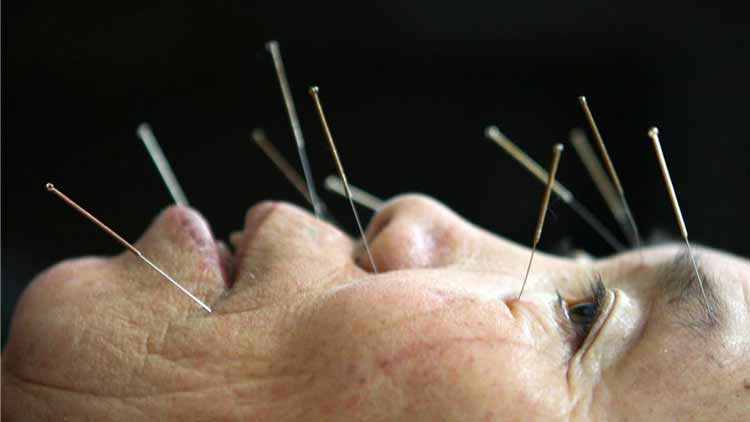 അ​​ക്യൂ​​പ​​ങ്​​​ച​​ർ: ശ​​രി​​യും തെ​​റ്റും