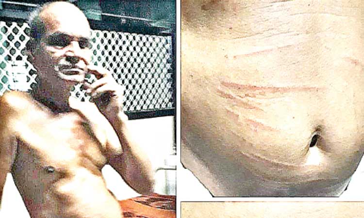 ശസ്​ത്രക്രിയക്കായി രോമം നീക്കി; രോഗിയുടെ ശരീരം മുഴുവൻ മുറിവ്​