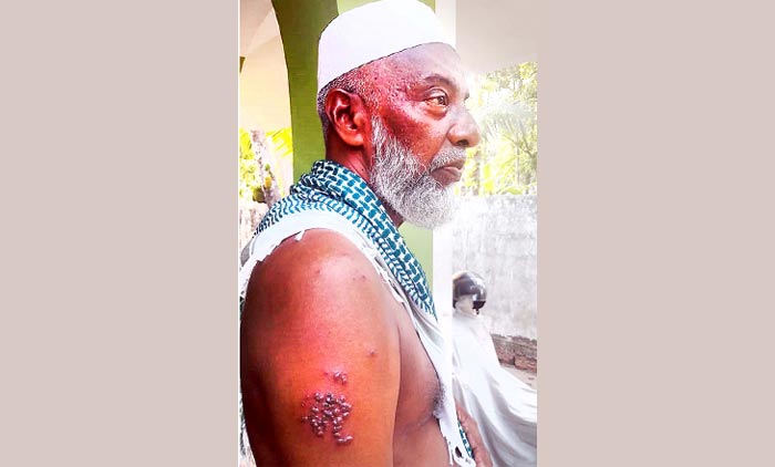 രണ്ടു പേർക്ക് സൂ​ര്യാ​ത​പ​മേ​റ്റു