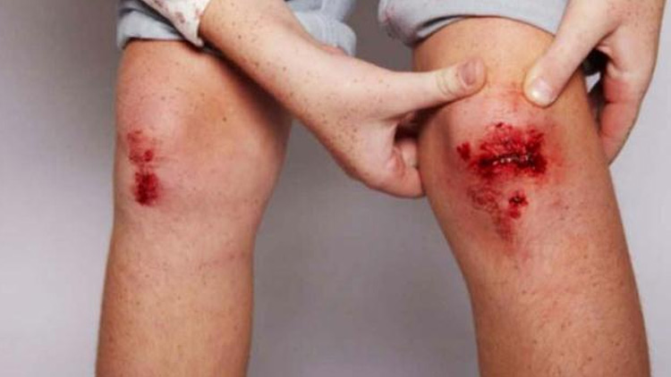 bleeding-in-knee.jpg