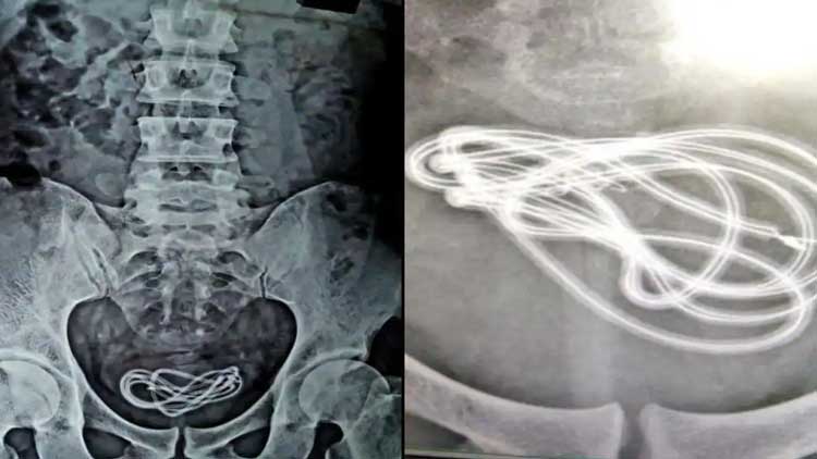 വയറുവേദനയുമായി ആശുപത്രിയിലെത്തിയ യുവാവി​െൻറ മൂത്രസഞ്ചിയിൽ നിന്ന്​ പുറത്തെടുത്തത്​ ചാർജിങ്​ കേബ്​ൾ