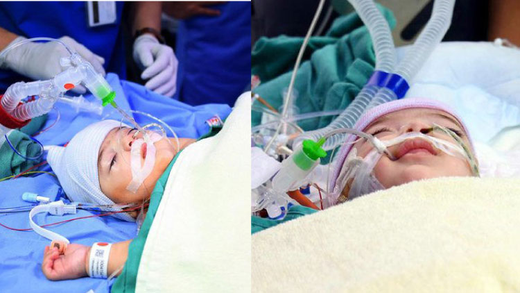 ലി​ബി​യ​ന്‍ സ​യാ​മീ​സു​ക​ളു​ടെ  ശ​സ്ത്ര​ക്രി​യ പൂ​ര്‍ത്തി​യാ​യി