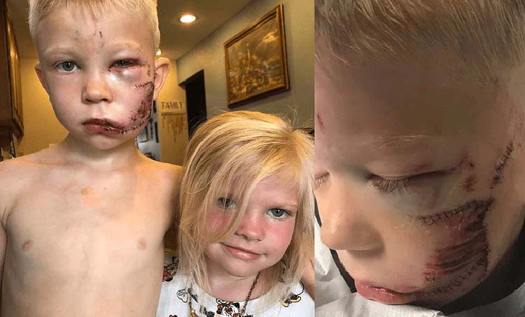 കുഞ്ഞുപെങ്ങളെ നായയിൽനിന്ന്​ രക്ഷിച്ചു;  ആറ്​ വയസുകാര​െൻറ ശരീരത്ത്​ 90 തുന്നലുകൾ