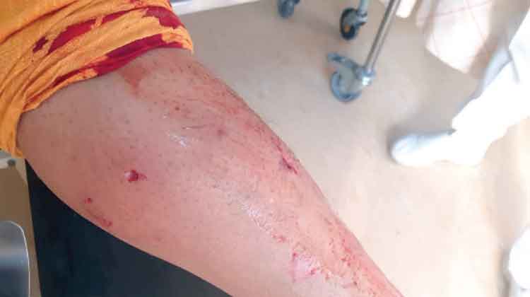 തെ​രു​വു​നാ​യു​ടെ ആ​ക്ര​മ​ണ​ത്തി​ൽ സ്ത്രീ​ക്കു പ​രി​​ക്ക്