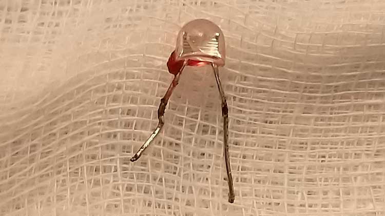 ഏഴ് വയസ്സുകാരിയുടെ ശ്വാസകോശത്തിൽ കുടുങ്ങിയ എൽ.ഇ.ഡി ബൾബ് പുറത്തെടുത്തു