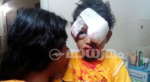 തെരുവുനായ ആക്രമണം: കുട്ടിയുടെ ചികിത്സക്ക് വിദഗ്ധ സംഘം