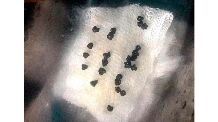 മധ്യവയസ്കയുടെ പിത്താശയത്തിൽനിന്ന് നീക്കിയത് 26 കല്ലുകൾ മധ്യവയസ്കയുടെ പിത്താശയത്തിൽനിന്ന് നീക്കിയത് 26 കല്ലുകൾ