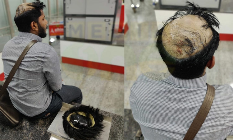 തലയിലൊളിപ്പിച്ച 25 ലക്ഷത്തിൻെറ സ്വര്‍ണവുമായി യുവാവ് പിടിയിൽ