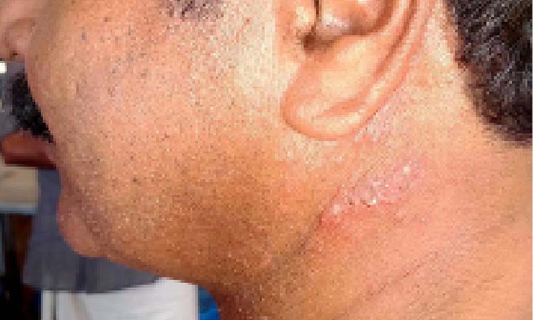 ജില്ലയിൽ നിരവധിപേർക്ക് സൂര്യാതപമേറ്റു