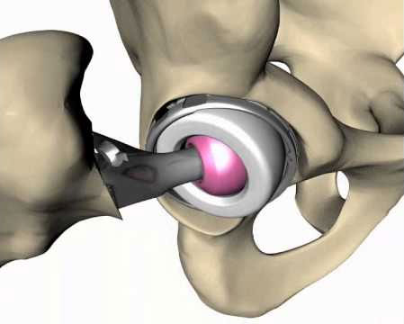 കൃത്രിമ കാല്‍മുട്ട് ശസ്ത്രക്രിയയില്‍ പുതിയ വഴിത്തിരിവ്