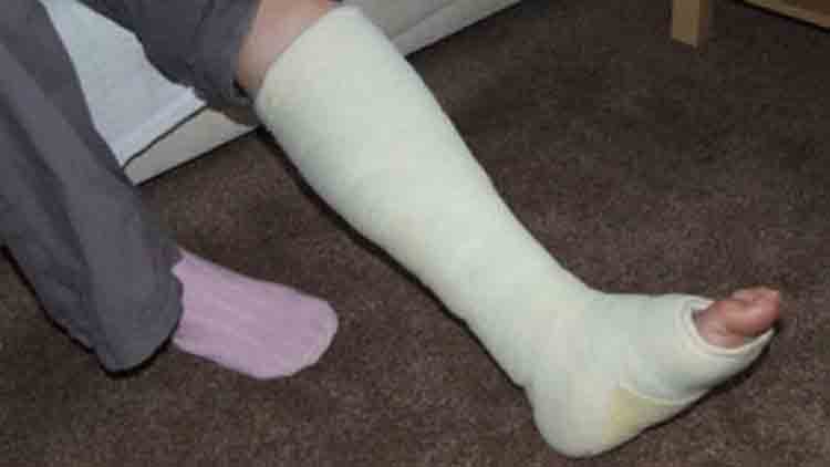 കാ​ലി​ന് പ​രി​ക്കേ​റ്റ്​ ചികിത്സയിൽ കഴിഞ്ഞ സ്ത്രീക്ക് കോവിഡ്