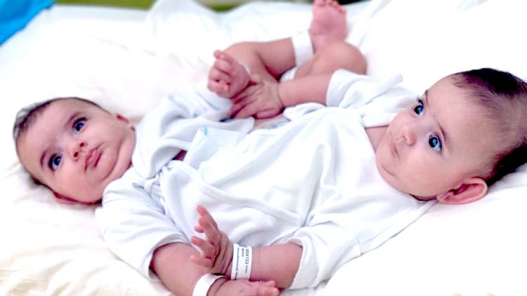 ലി​ബി​യ​ൻ സ​യാ​മീ​സ്​ ഇ​ര​ട്ട​ക​ൾ​ക്ക്​ നാ​ളെ ശ​സ്​​ത്ര​ക്രി​യ