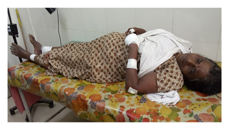 കണ്ണൂരിൽ തൊഴിലുറപ്പ് പണിക്കിടെ ബോംബ് സ്ഫോടനം; ഒരാൾ പരിക്ക്​